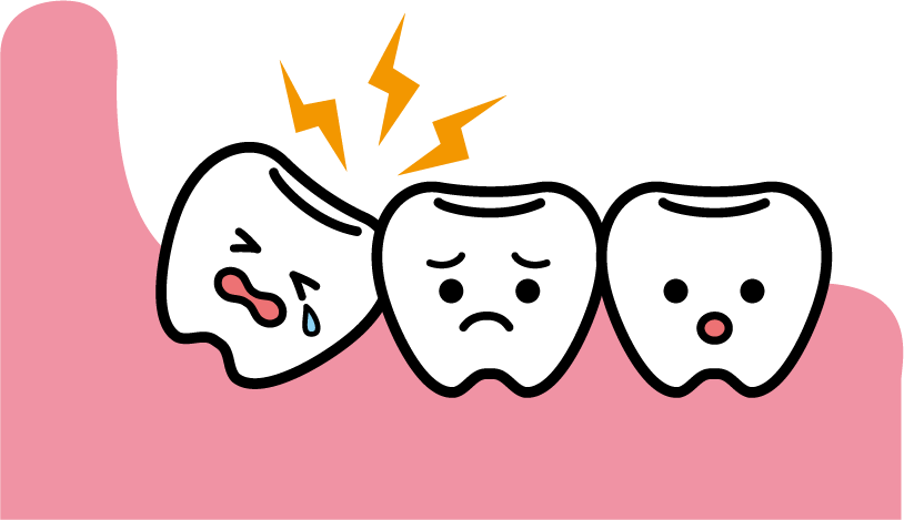 親知らずの抜歯