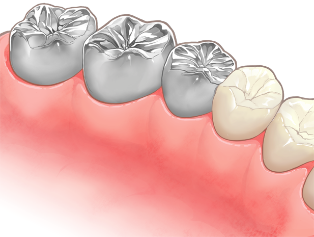 銀歯(保険適用)