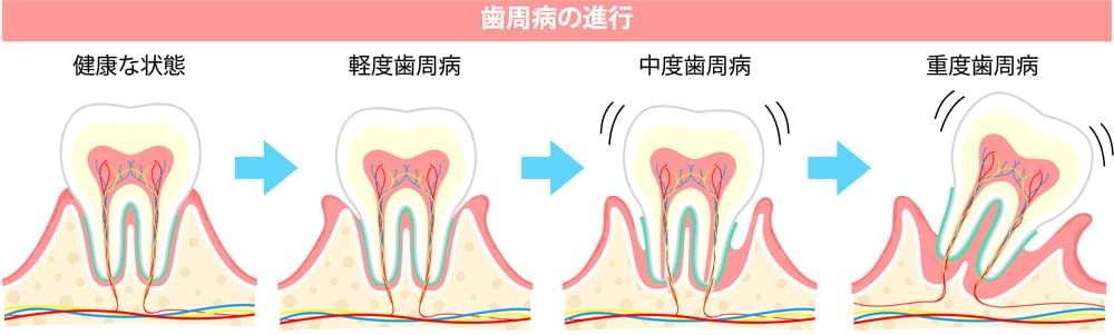 歯周病について