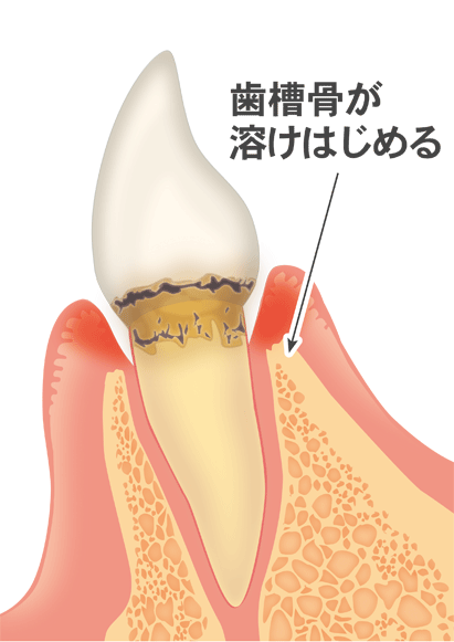 軽度の歯周炎