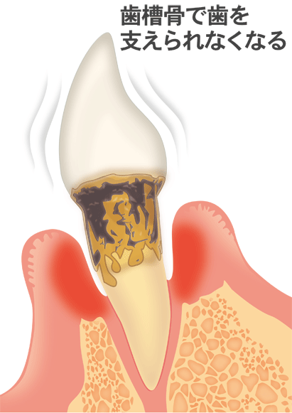 重度の歯周炎